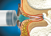 Ear Wax Removal Syringe