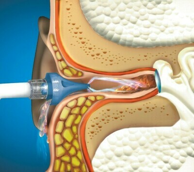 Bionix OtoClear® Ear SprayWash Kit