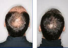 Tratamiento para alopecia con plasma rico en plaquetas