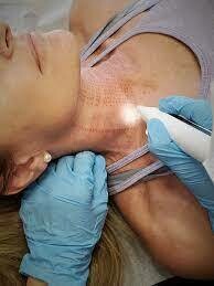 Lifting de cuello con plasma terapia