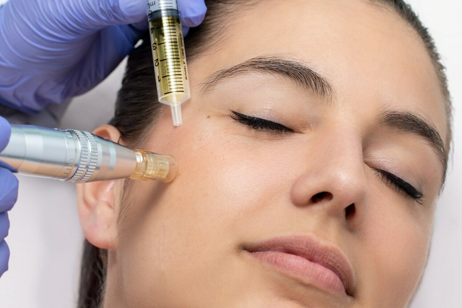 Bioestimulación con plasma rico en plaquetas (PRP)