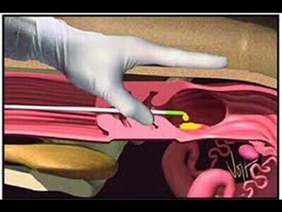 Inseminación Artificial