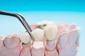 Puentes dentales
