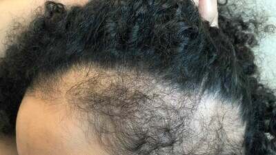 Hair Loss Solutions