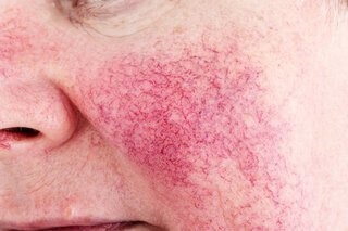 Looking after your Rosacea skin