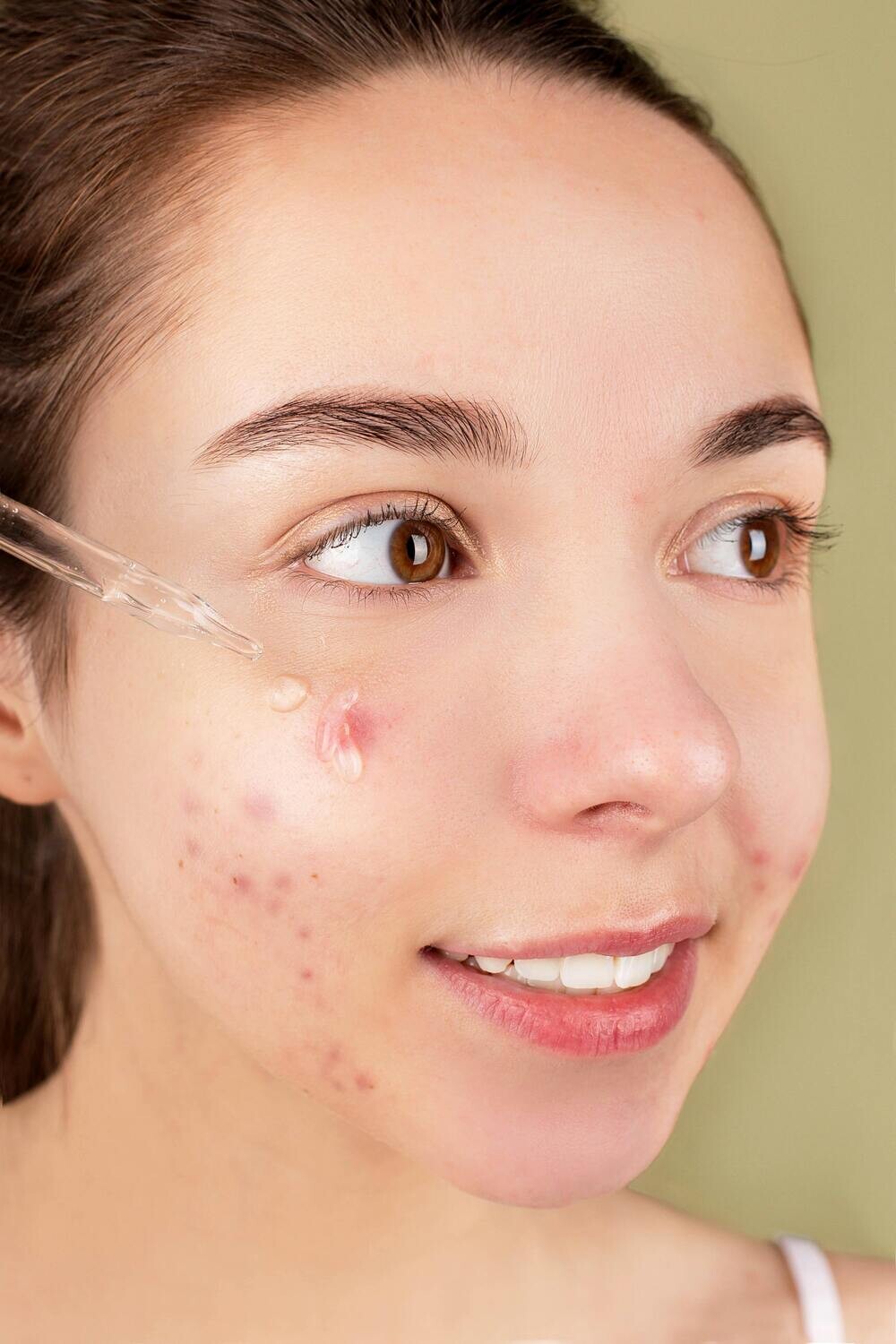 Teenage Acne Facials