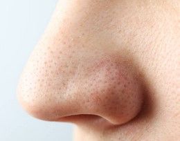 Blackheads
