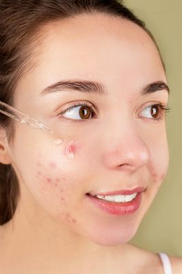 Clear Skin Teen Treatment