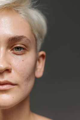 Clear and Renew Acne Treatment
