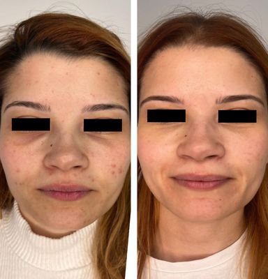 Microneedling with Exosomes