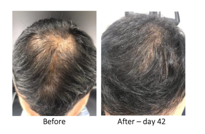 Hair Loss Treatment