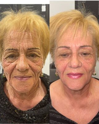 Non surgical Microlifting Facial Treatment