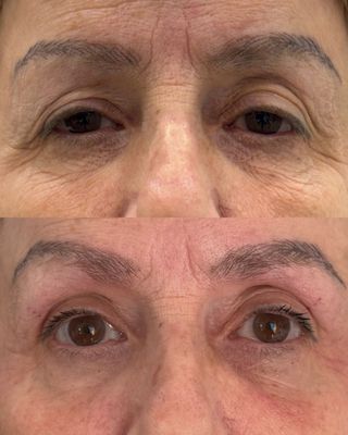Non surgical Blepharoplasty (eye lift)
