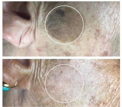 Pigment Removal
