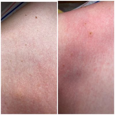 Skin Tag Removal