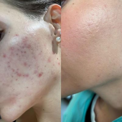 Acne Scar Treatment