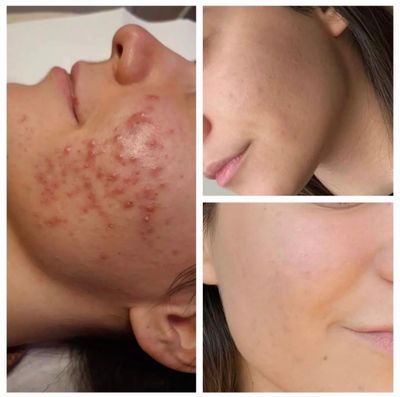Active Acne Treatment
