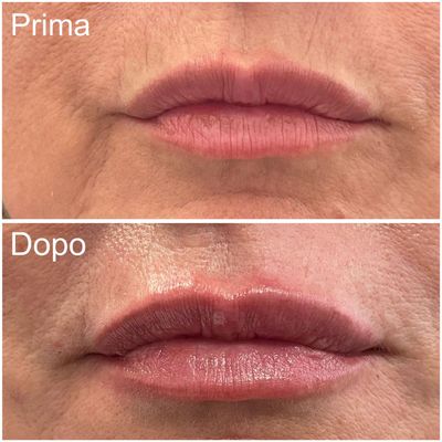 Lip Plump