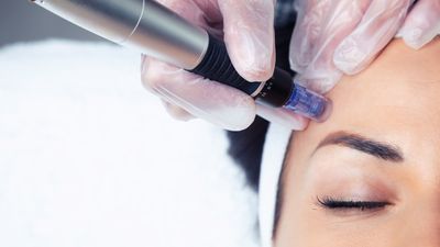 Regenerative Microneedling