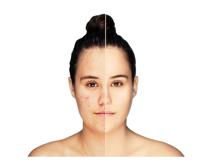 8 Week Clear Skin Programme