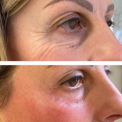 Non-Surgical Skin Tightening