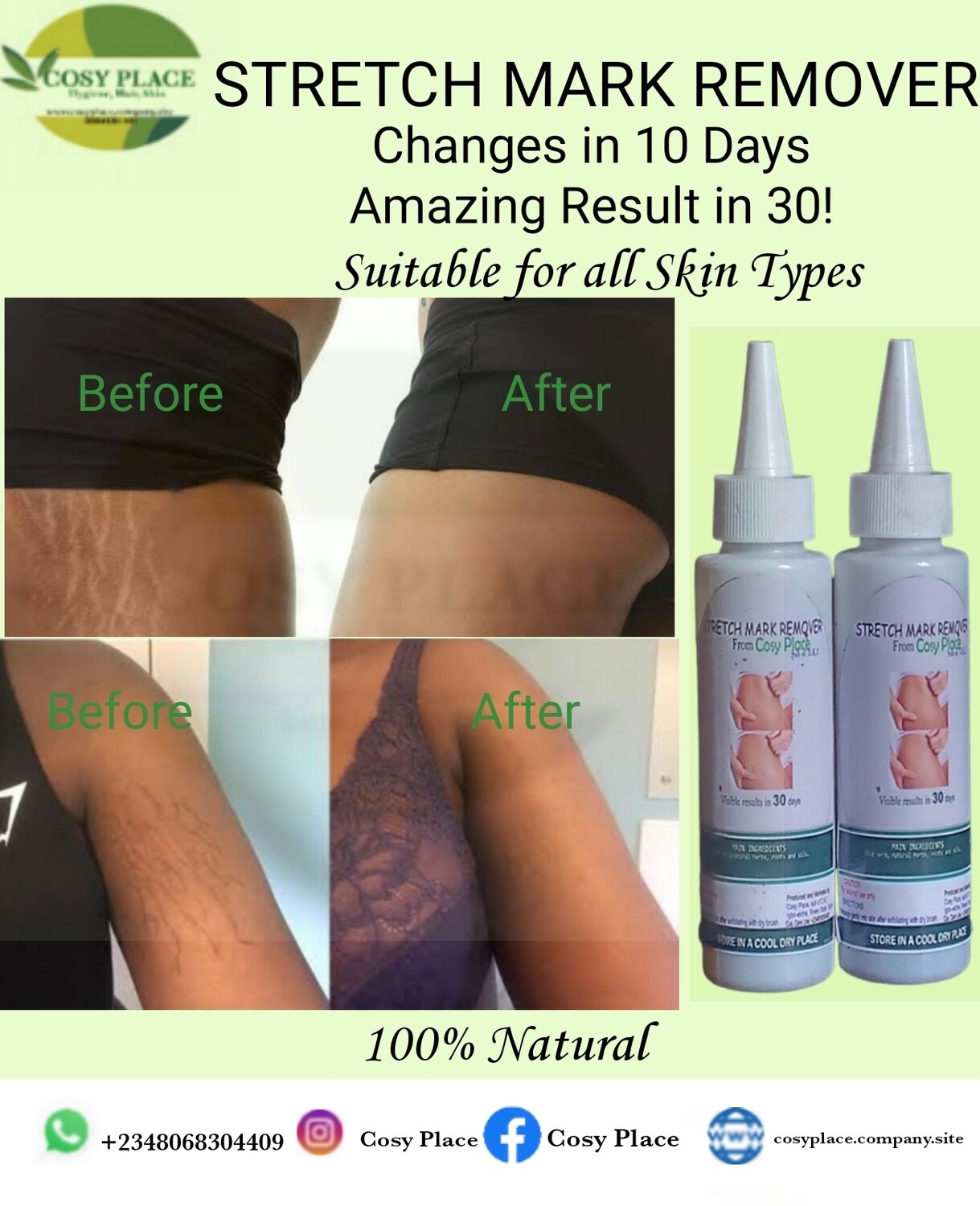 STRETCH MARK REMOVER