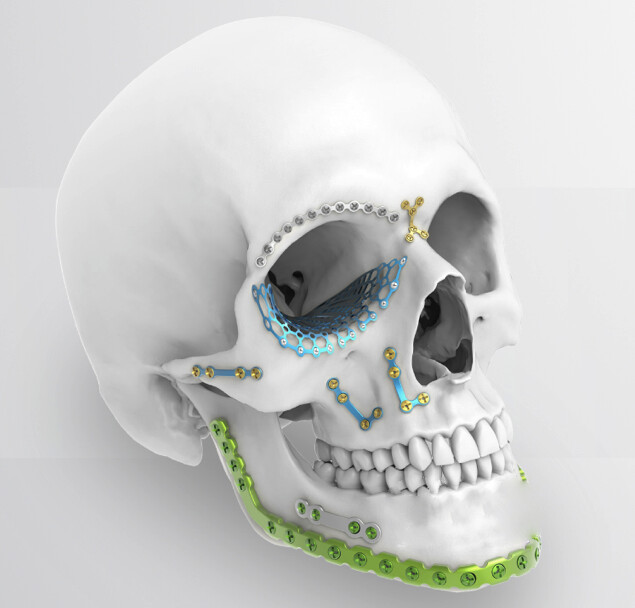 Sistema de sujeción para fracturas.