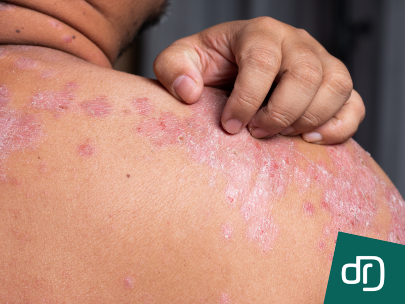 Doenças da Pele - Alergias - Dermatite