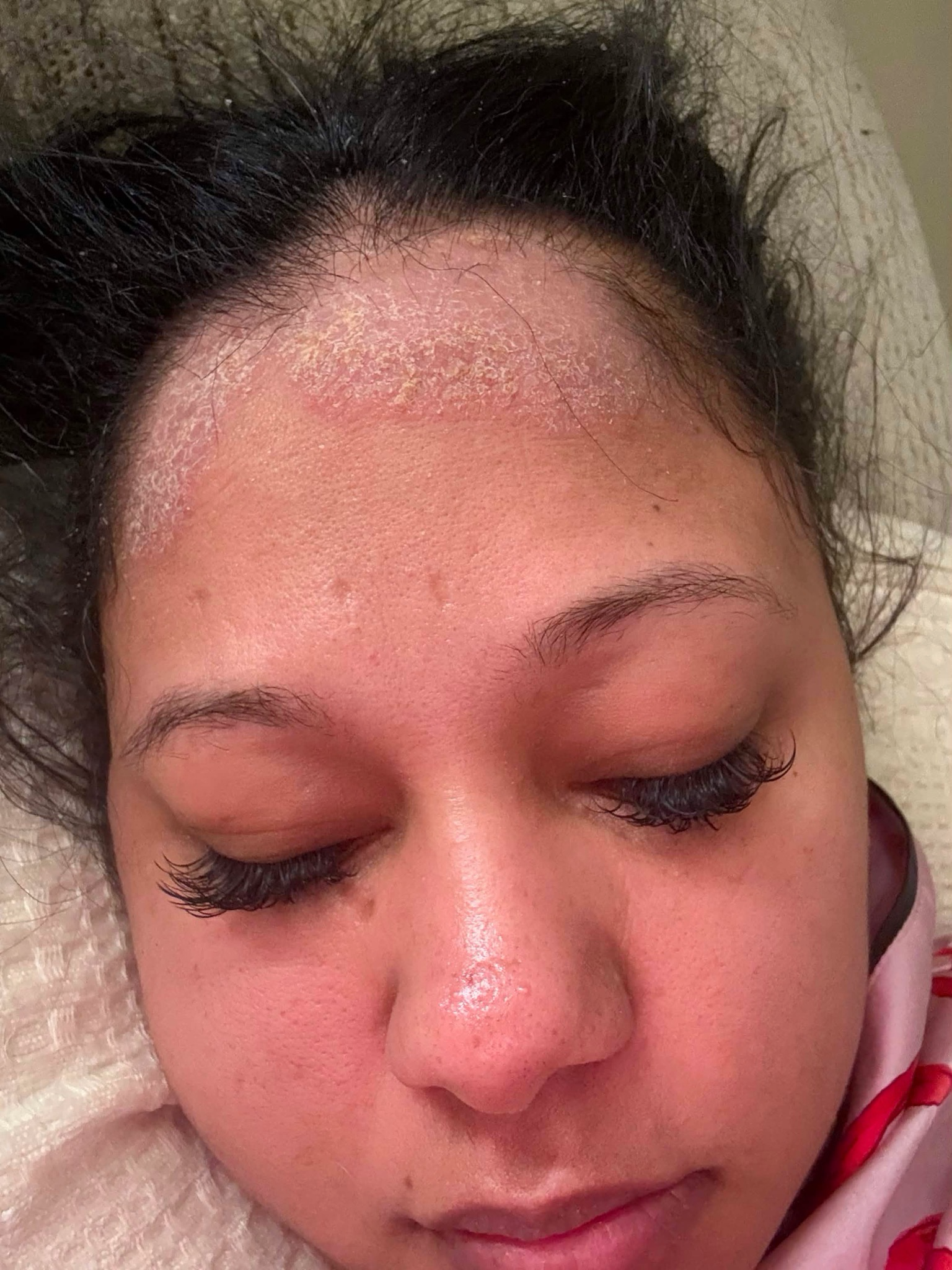 RUTINA INTENSIVA PARA EL EQUILIBRIO DEL CUERO CABELLUDO Set de 8 pasos de Ajo para la psoriasis, exceso de grasa y caspa.