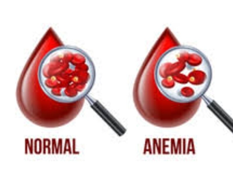 Anemia