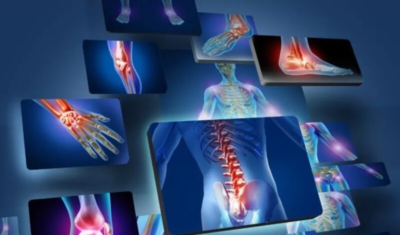 Arthritis/rheumatism