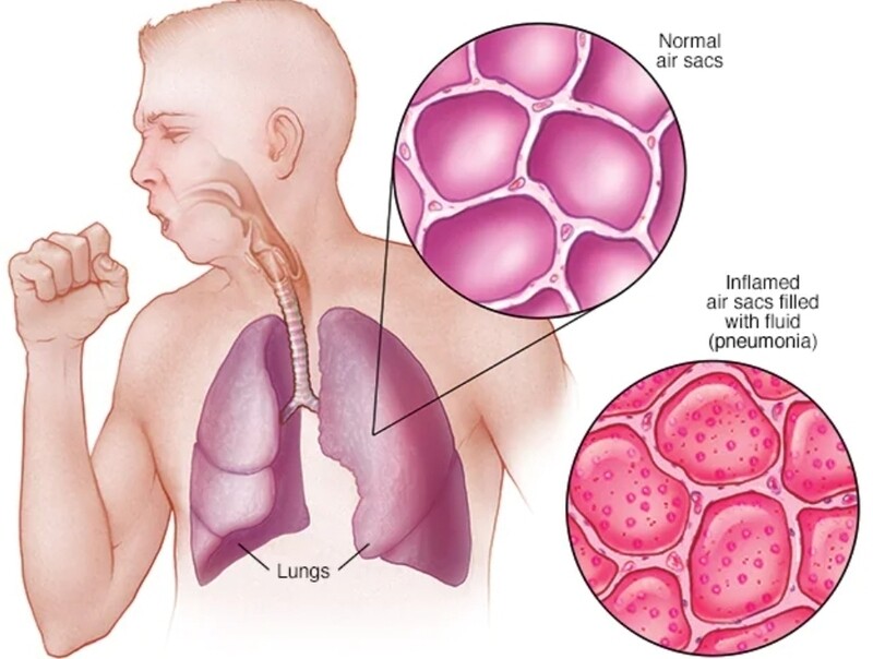 Lung infections