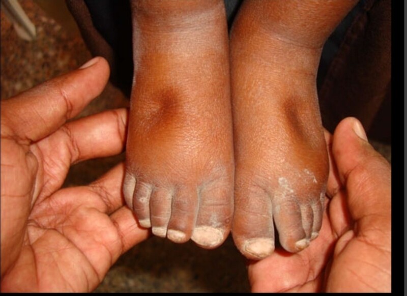 OEDEMA