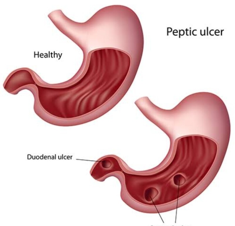 Ulcers