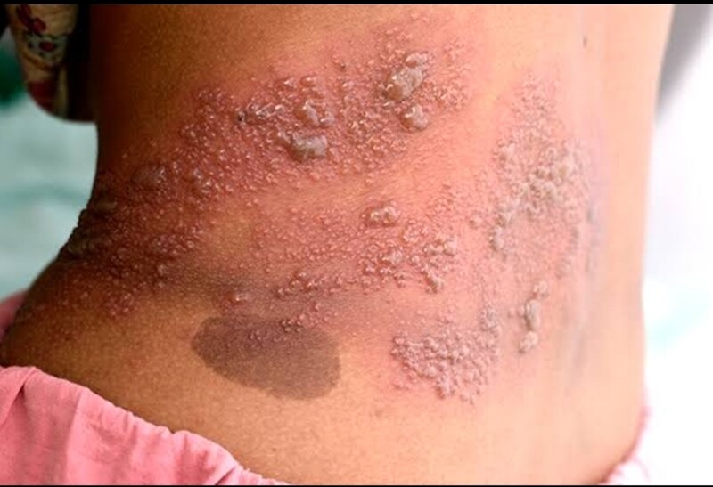 Shingles
