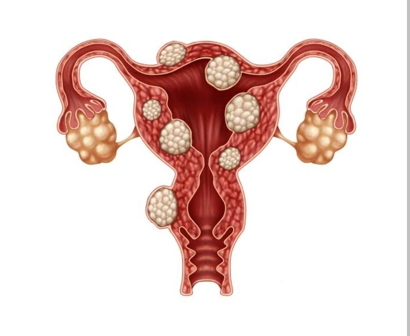 How to treat fibroids naturally?