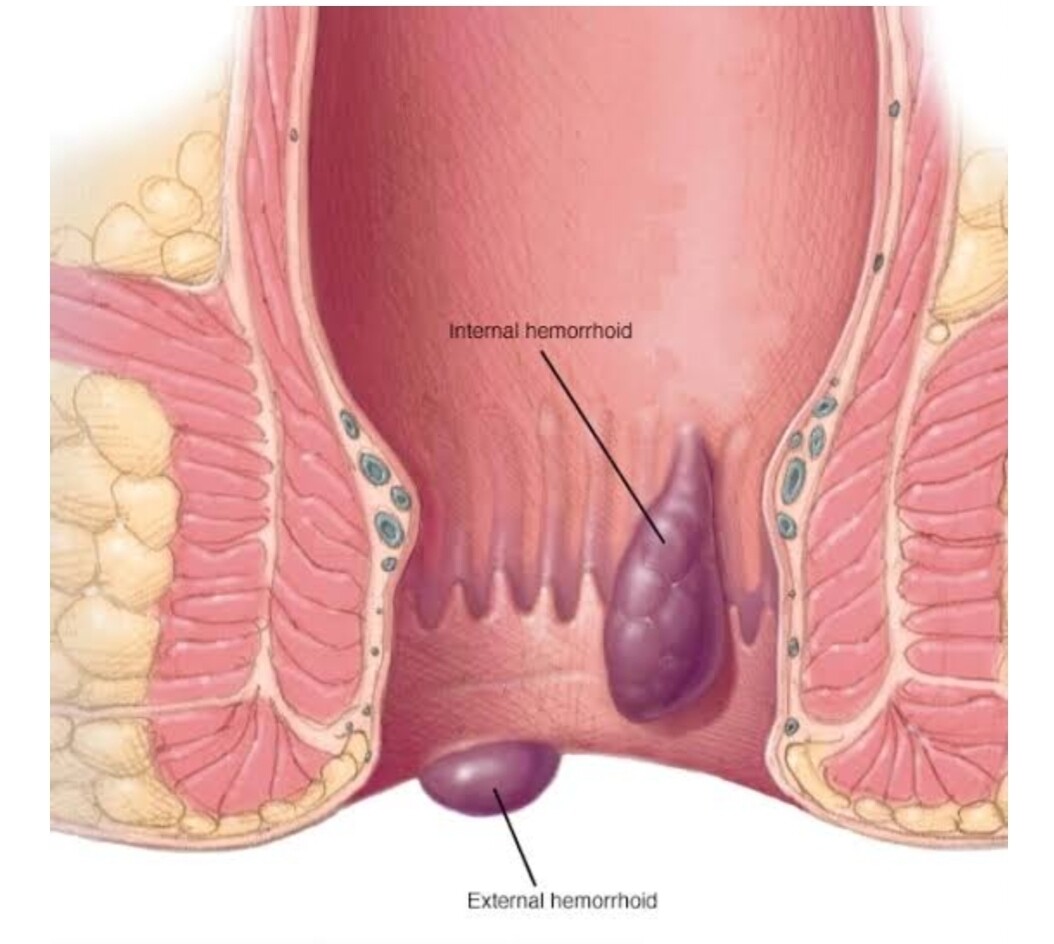 Haemorrhoids treatment package 