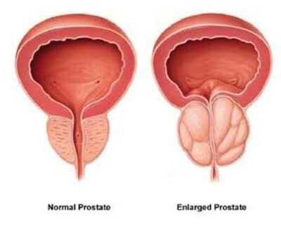 Prostate disorders treatment