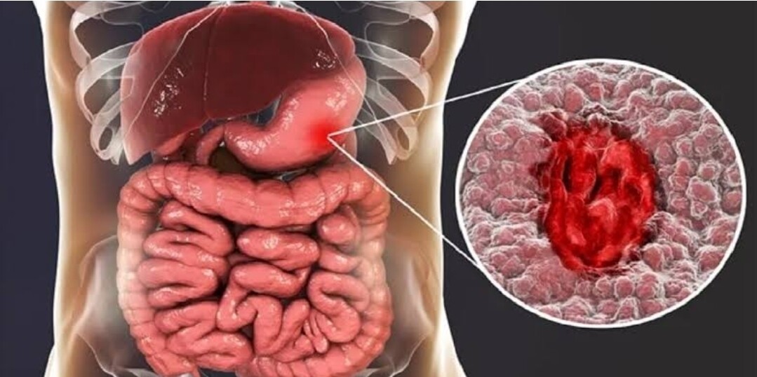 Ulcers treatment package