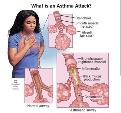 Asthma treatment pack