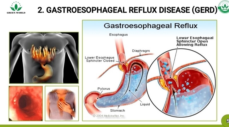 ACIDITY, STOMACH PROBLEMS, DIGESTIVE DISORDERS