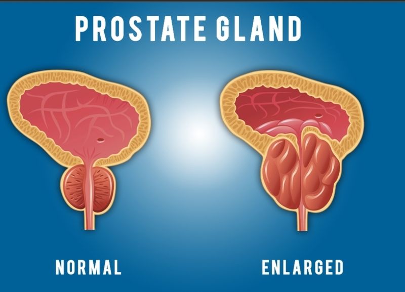 How to treat Green world prostate enlargement