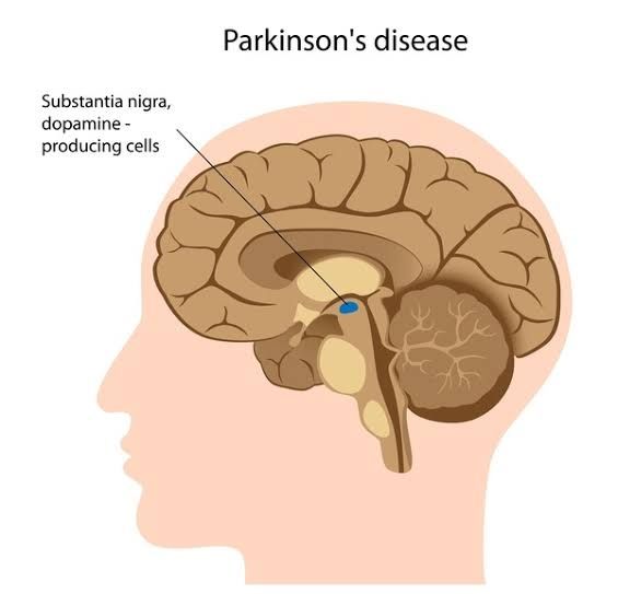 Parkinson&#39;s disease