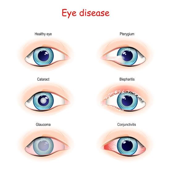 Eye disorders