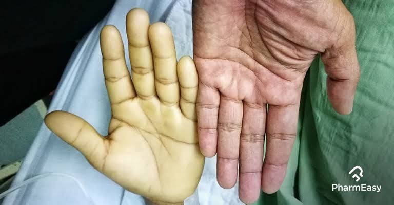 Anemia