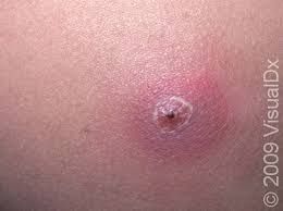 Bed sore/boil