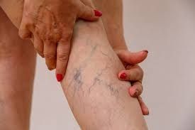 Thromboembolism
