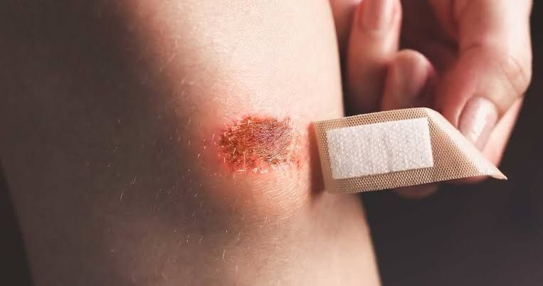 Wounds