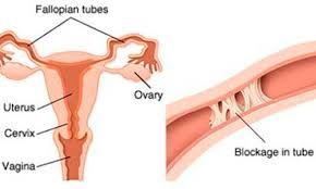 Fallopian tubes blockage