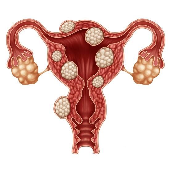 Fibroids